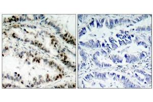 Immunohistochemical analysis of paraffin-embedded human lung carcinoma tissue using SMC1(Phospho-Ser957) Antibody(left) or the same antibody preincubated with blocking peptide(right). (SMC1A anticorps  (pSer957))