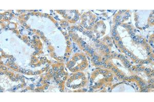 Immunohistochemistry of paraffin-embedded Human thyroid cancer using SPHK2 Polyclonal Antibody at dilution of 1:60 (SPHK2 anticorps)