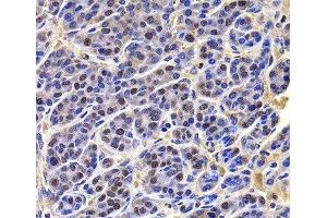 Immunohistochemistry of paraffin-embedded Human liver cancer using HIRIP3 Polyclonal Antibody at dilution of 1:100 (40x lens).
