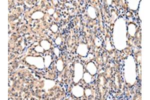 The image on the left is immunohistochemistry of paraffin-embedded Human thyroid cancer tissue using ABIN7127988(PPIL1 Antibody) at dilution 1/30, on the right is treated with fusion protein. (PPIL1 anticorps)