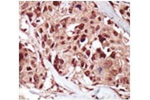 IHC analysis of FFPE human breast carcinoma tissue stained with the BRD4 antibody