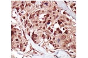 IHC analysis of FFPE human breast carcinoma tissue stained with the BRD4 antibody (BRD4 anticorps  (AA 1-30))