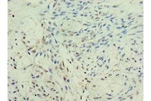 Immunohistochemistry of paraffin-embedded human breast cancer using ABIN7157755 at dilution of 1:100 (KMO anticorps  (AA 1-260))