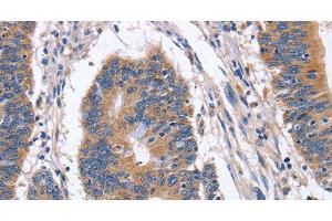 Immunohistochemistry of paraffin-embedded Human colon cancer tissue using BMP6 Polyclonal Antibody at dilution 1:40