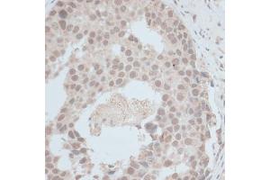 Immunohistochemistry of paraffin-embedded human breast cancer using ZNF703 antibody (ABIN7271524) at dilution of 1:100 (40x lens).