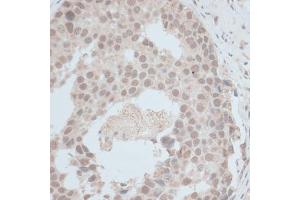 Immunohistochemistry of paraffin-embedded human breast cancer using ZNF703 antibody (ABIN7271524) at dilution of 1:100 (40x lens). (ZNF703 anticorps  (AA 160-290))