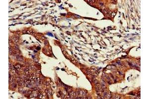 Immunohistochemistry of paraffin-embedded human colon cancer using ABIN7176539 at dilution of 1:100 (Zinc Finger Protein 816A (ZNF816A) (AA 1-200) anticorps)
