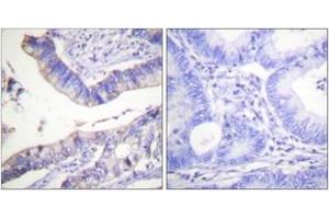 Immunohistochemistry analysis of paraffin-embedded human colon carcinoma tissue, using BCL-2 (Ab-69) Antibody. (Bcl-2 anticorps  (AA 46-95))