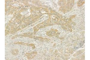 ABIN6261103 and ABIN6276877 at 1/100 staining human tongue carcinoma by IHC-P.