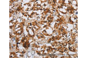 Immunohistochemistry of Human esophagus cancer using DSP Polyclonal Antibody at dilution of 1:40 (Desmoplakin anticorps)