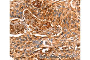 Immunohistochemistry of Human esophagus cancer using LGALS1 Polyclonal Antibody at dilution of 1:25 (LGALS1/Galectin 1 anticorps)