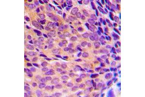 Immunohistochemical analysis of NF-kappaB p105/p50 (pS337) staining in human breast cancer formalin fixed paraffin embedded tissue section.