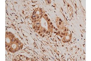 ABIN6269405 at 1/50 staining human colon cancer tissue sections by IHC-P. (HDAC5 anticorps)