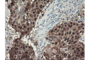 Immunohistochemical staining of paraffin-embedded Carcinoma of Human lung tissue using anti-ADH7 mouse monoclonal antibody. (ADH7 anticorps)