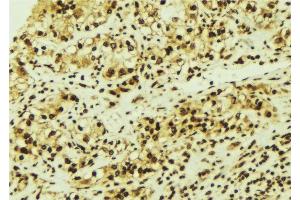 ABIN6276713 at 1/100 staining Human breast cancer tissue by IHC-P. (CDK6 anticorps  (N-Term))