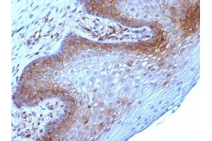 Formalin-fixed, paraffin-embedded human Cervical Carcinoma stained with Beta-2-Microglobulin Mouse Monoclonal Antibody (B2M/961).