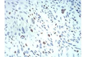 Immunohistochemical analysis of paraffin-embedded esophageal cancer tissues using KPNA2 mouse mAb with DAB staining.