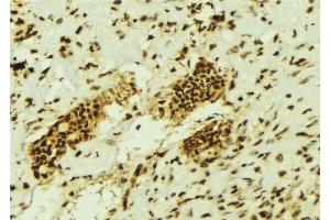 ABIN6274457 at 1/100 staining Human breast cancer tissue by IHC-P. (EZH1 anticorps  (Internal Region))