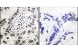 Immunohistochemistry analysis of paraffin-embedded human lung carcinoma tissue, using CBP (Ab-1535) Antibody. (CBP anticorps  (AA 1501-1550))
