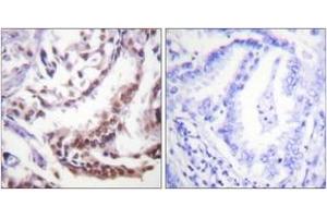 Immunohistochemistry analysis of paraffin-embedded human lung carcinoma tissue, using Histone H3 (Acetyl-Lys9) Antibody. (Histone 3 anticorps  (H3K9ac))