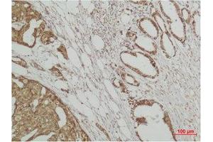 Immunohistochemistry (IHC) analysis of paraffin-embedded Human Breast Carcicnoma using ERK 3 Polyclonal Antibody.
