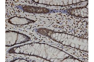 Immunoperoxidase of monoclonal antibody to CTDP1 on formalin-fixed paraffin-embedded human colon.
