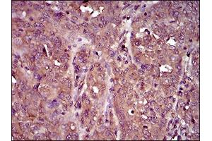 Immunohistochemical analysis of paraffin-embedded ovarian cancer tissues using IL3RA mouse mAb with DAB staining.