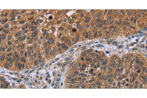 Immunohistochemistry of paraffin-embedded Human lung cancer tissue using IHH Polyclonal Antibody at dilution 1:30 (Indian Hedgehog anticorps)