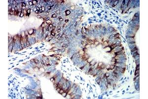 Immunohistochemical analysis of paraffin-embedded colon cancer tissues using KRT20 mouse mAb with DAB staining. (KRT20 anticorps  (AA 1-150))