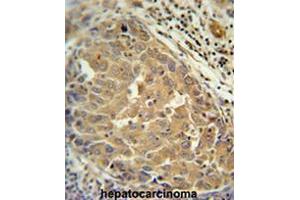 FGF2 Antibody (Center) immunohistochemistry analysis in formalin fixed and paraffin embedded human hepatocarcinoma followed by peroxidase conjugation of the secondary antibody and DAB staining.