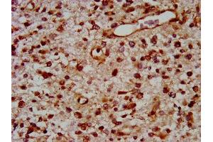 IHC image of ABIN7172127 diluted at 1:400 and staining in paraffin-embedded human glioma performed on a Leica BondTM system. (TOX anticorps  (AA 141-288))