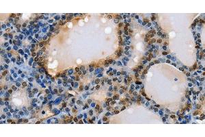 Immunohistochemistry of paraffin-embedded Human thyroid cancer using NFKBID Polyclonal Antibody at dilution of 1:40 (NFKBID anticorps)