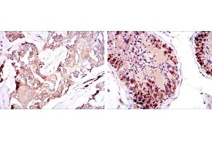 Immunohistochemical analysis of paraffin-embedded breast cancer tissues (left) and testis tissues (right) using SMN1 mouse mAb with DAB staining.