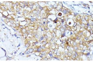 Immunohistochemistry of paraffin-embedded Human mammary cancer using EIF3L Polyclonal Antibody at dilution of 1:100 (40x lens). (EIF3L anticorps)