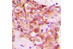 Immunohistochemical analysis of Collagen 5 alpha 1 staining in human breast cancer formalin fixed paraffin embedded tissue section.