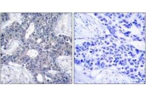 Immunohistochemistry analysis of paraffin-embedded human breast carcinoma tissue, using ZAP-70 (Ab-493) Antibody. (ZAP70 anticorps  (AA 460-509))