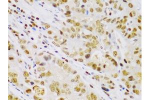 Immunohistochemistry of paraffin-embedded human gastric cancer using IKKβ antibody (ABIN3022875, ABIN3022876, ABIN3022877 and ABIN6219275) at dilution of 1:100 (40x lens).