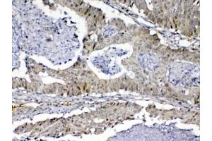 IHC testing of FFPE human colon cancer tissue with MED9 antibody at 1ug/ml. (MED9 anticorps)