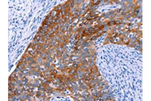 The image on the left is immunohistochemistry of paraffin-embedded Human cervical cancer tissue using ABIN7192345(SGK2 Antibody) at dilution 1/20, on the right is treated with synthetic peptide.