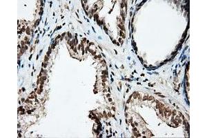 Immunohistochemical staining of paraffin-embedded Carcinoma of liver tissue using anti-PTPRE mouse monoclonal antibody. (PTPRE anticorps)