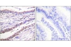 Immunohistochemistry analysis of paraffin-embedded human lung carcinoma tissue, using Cyclin A Antibody. (Cyclin A anticorps  (AA 221-270))