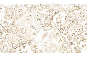 Detection of GAL3 in Human Lung cancer Tissue using Monoclonal Antibody to Galectin 3 (GAL3)