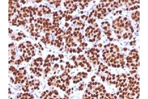 IHC testing of FFPE human prostate carcinoma with FOXA1 antibody (clone FOXA1/1512). (FOXA1 anticorps  (AA 372-472))