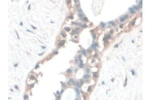 Detection of COQ6 in Human Breast cancer Tissue using Polyclonal Antibody to Coenzyme Q6 Homolog, Monooxygenase (COQ6)