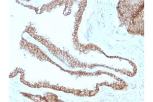 Formalin-fixed, paraffin-embedded human Prostate Carcinoma stained with Catenin, gamma Mouse Monoclonal Antibody (CTNG/1664)