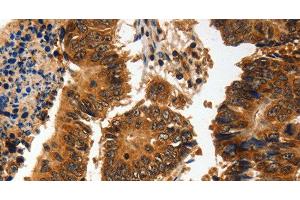 Immunohistochemistry of paraffin-embedded Human colon cancer using ADAP1 Polyclonal Antibody at dilution of 1:60