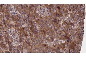 ABIN6277373 at 1/100 staining Human liver cancer tissue by IHC-P. (Connexin 31 anticorps  (C-Term))