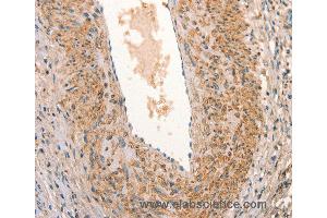 Immunohistochemistry of Human cervical cancer using ARFRP1 Polyclonal Antibody at dilution of 1:25 (ARFRP1 anticorps)