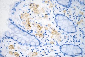 Immunohistochemistry was performed on paraffin-embedded human sigmoid colon carcinoma using JNK1 antibody (ABIN7799457), 1:200). (Recombinant JNK anticorps)