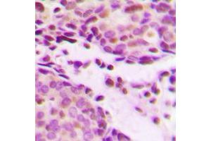 Immunohistochemical analysis of Histone H2B (AcK12) staining in human breast cancer formalin fixed paraffin embedded tissue section.